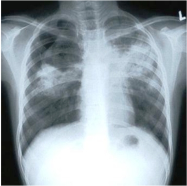 TB chest X-Ray