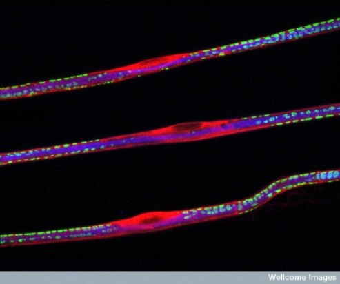 Defects in a single gene knock out lysosomal activity in nerve cells of the central and peripheral nervous system in metachromatic leukodystrophy patients. Peter Brophy, Wellcome Images.